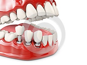 Human teeth and Dental implant. 3d illustration