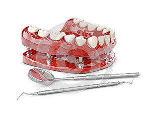 Human teeth and Dental implant. 3d illustration
