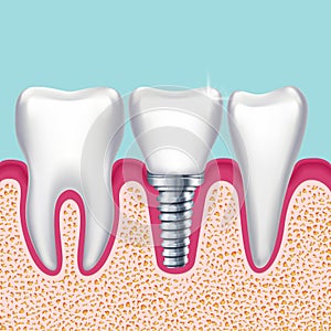 Human teeth and dental implant in jaw orthodontist medical vector illustration