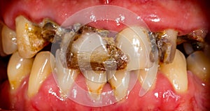 Human teeth before dental treatment