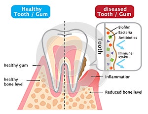 Healthy and diseased gum. dental biofilm. dental and health care concept photo