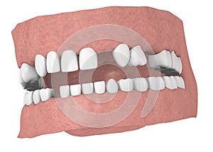 Human teeth without some teeths