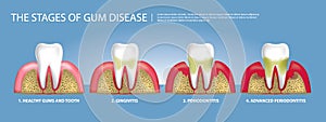 Human teeth Stages of Gum Disease