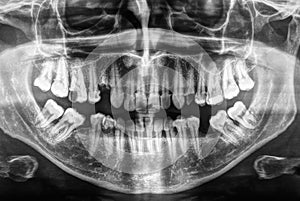 Human teeth xray in black and white
