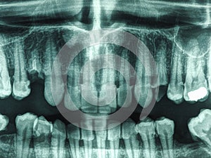 Human teeth xray
