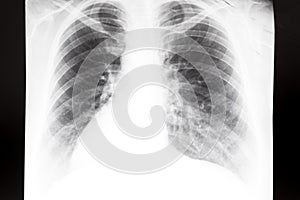 Human thorax with lungs on X-ray image