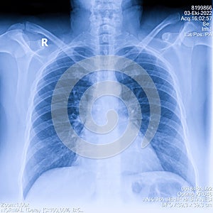 Human thorax x-ray for lungs examination, PA up right. Cancer infected lungs. Virus screening