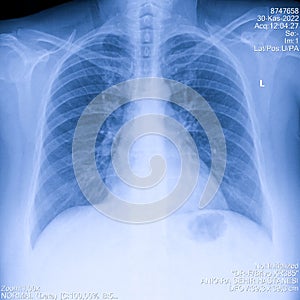 Human thorax x-ray for lungs examination, PA up right. Cancer infected lungs. Virus screening