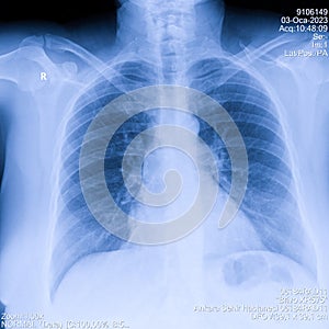 Human thorax x-ray for lungs examination, PA up right. Cancer infected lungs. Virus screening