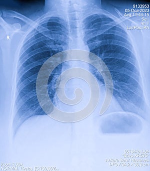 Human thorax x-ray for lungs examination, PA up right. Cancer infected lungs. Virus screening
