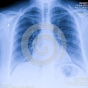 Human thorax x-ray for lungs examination, PA up right. Cancer infected lungs. Virus screening