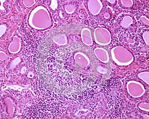 Human thyroid. Chronic thyroiditis