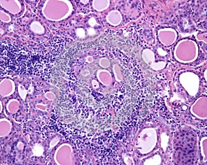 Human thyroid. Chronic thyroiditis