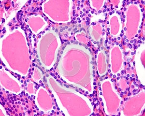 Human thyroid gland. Follicular adenoma