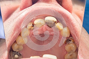 Human tooth decay close-up at the dentist`s appointment. Poor oral hygiene, prevention