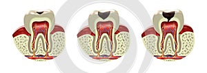 Human tooth decay disease cross section realistic view