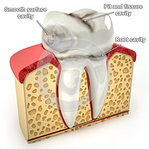 Human tooth, with types of caries (3d model)
