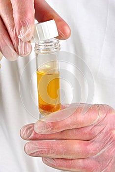 human urine in a sample bottle