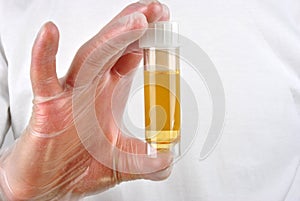 human urine in a sample bottle