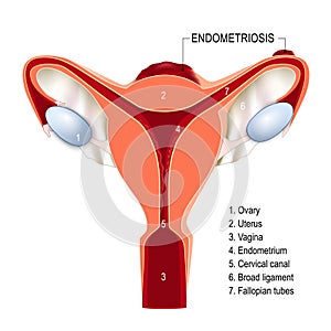 Human Uterus with Endometriosis photo