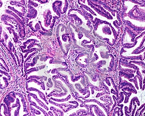 Human uterus. Endometroid carcinoma