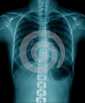 Chest x-ray show inside of lung