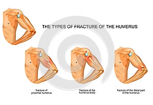 Humerus fracture, trauma, surgery