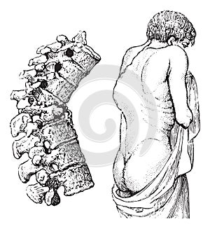 Hump of the vertebral disease or Pott`s disease, vintage engravi