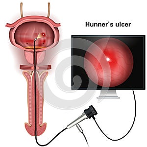 Hunner`s ulcer 3d medical vector illustration on white background