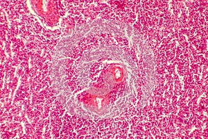 Hyaline degeneration of splenic artery