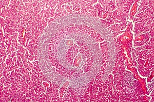 Hyaline degeneration of splenic artery photo