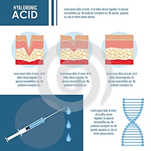 Hyaluronic acid filler injection infographic