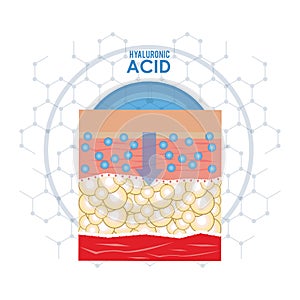 Hyaluronic acid filler injection infographic