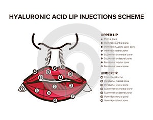 Hyaluronic acid filler. Lip injections. Lip anatomy photo