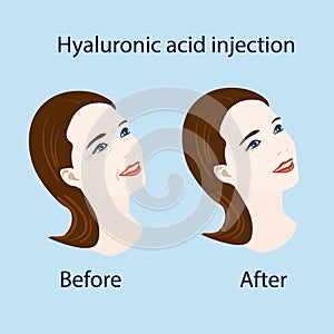 Hyaluronic acid injection, before and affect , vector illustration