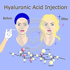 Hyaluronic acid injection, before and affect , vector illustration