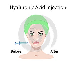 Hyaluronic acid injection, before and affect , vector illustration