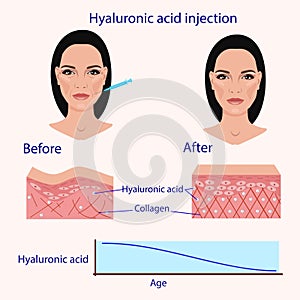 Hyaluronic acid injection, before and affect , vector illustration, diagram