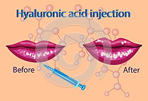 Hyaluronic acid injection,lips procedure vector illustration,