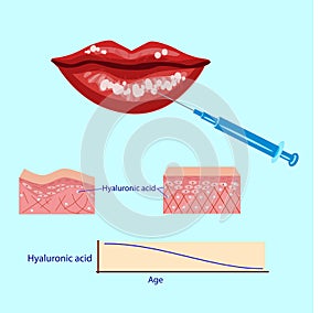 Hyaluronic acid injection,lips procedure vector illustration, diagram