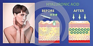Hyaluronic acid. skin-care products. skin rejuvenation photo