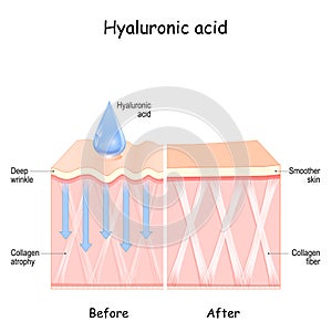 Hyaluronic acid. skin photo