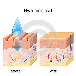 Hyaluronic acid. skin rejuvenation with help of hyaluronic acid