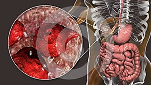 Hydatid cyst of Echinococcus granulosus in the liver photo