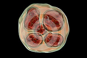 Hydatid cyst of Echinococcus multilocularis