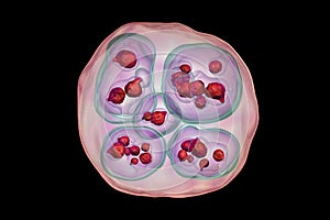 Hydatid cyst of Echinococcus multilocularis