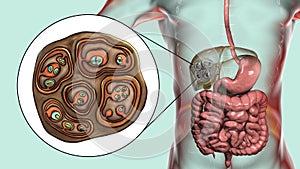 Hydatid cyst of Echinococcus multilocularis