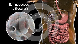 Hydatid cyst of Echinococcus multilocularis