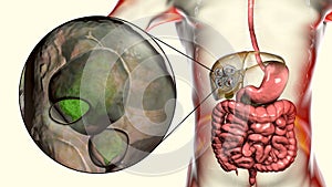 Hydatid cyst of Echinococcus multilocularis