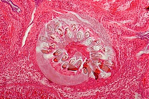 Hydatid cyst of liver caused by tapeworm parasite Echinococcus granulosus